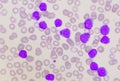 Group of blast cells in leukemia background