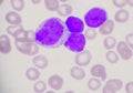 Group of blast cells in leukemia background