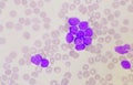 Group of blast cells in leukemia background