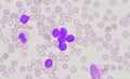 Group of blast cells in leukemia background