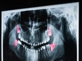 Growing Wisdom Teeth Pain On X-Ray Royalty Free Stock Photo