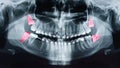 Growing Wisdom Teeth Pain On X-Ray Royalty Free Stock Photo