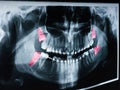 Growing Wisdom Teeth Pain On X-Ray Royalty Free Stock Photo