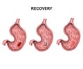 Growth of cancer in the bladder