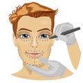 Guide lines for surgical incisions on a patient male face Royalty Free Stock Photo