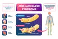 Guillain Barre syndrome vector illustration. Labeled muscle disease scheme. Royalty Free Stock Photo