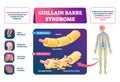 Guillain Barre syndrome vector illustration. Labeled muscle disease scheme.