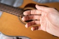 Guitarist's hand with peeling skin