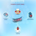 Gum disease complications poster Royalty Free Stock Photo