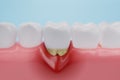 Gum disease, Gingival Recession or inflammation Royalty Free Stock Photo