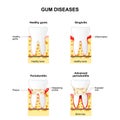 Gum disease Royalty Free Stock Photo