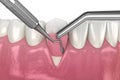 Gum Recession: Soft tissue graft surgery. 3D illustration of Dental treatment