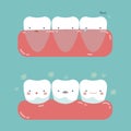 Gum surgery for nice teeth of dental