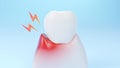 Gums gum inflammation, gingival recession Royalty Free Stock Photo