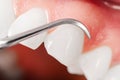 Gums and teeth examination. Close up Royalty Free Stock Photo