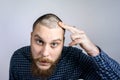 Guy with alopecia on head, touching hair and looks in the mirror. Spot Baldness, Hair fall problem Royalty Free Stock Photo