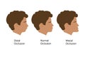 Guy with Distal, Normal, and Mesial bite profile, vector illustration. Overbite or underbite before and after