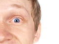 The guy eye disease Royalty Free Stock Photo