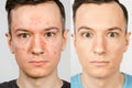 Two guys before-after: left guy with acne, red spots, problem skin, right guy with healthy skin. Acne treatment concept
