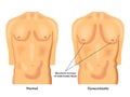 Gynecomastia