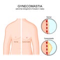 Gynecomastia. Torso of healthy man and abnormal enlargement of breasts in male Royalty Free Stock Photo