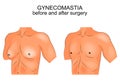 Gynecomasty. before and after surgery