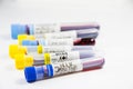 H1N1, Covid-19, Hepatitis C, Tuberculosis and Staphylococcus viruses blood tests in the tubes, laboratory diagnostics