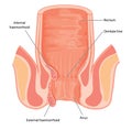 Haemorrhoids shown in cross section of anal canal Royalty Free Stock Photo