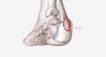 Haglund's deformity is bone growth on the back of the heel