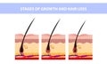 Hair growth phase step by step. Stages of the hair growth cycle. Anagen, telogen, catagen. Anatomy of the skin. Cross section of