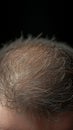 Hair health Adult male coping with baldness, alopecia, and hairline