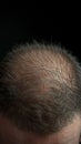 Hair health Adult male coping with baldness, alopecia, and hairline