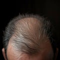 Hair health Adult male coping with baldness, alopecia, and hairline