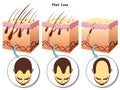 Hair loss