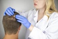 A trichologist examines the hair of a man who begins alopecia. Consultation with a dermatologist. Hair loss, alopecia, pruritus,