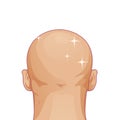 Hair loss. Bald hairstyle alopecia man problem vector medical health illustration Royalty Free Stock Photo