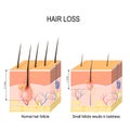 Hair loss baldness. Normal hair follicle and skin with Alopeci