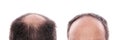 Hair loss Royalty Free Stock Photo