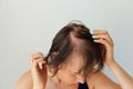 Bald patches of total alopecia of a woman Royalty Free Stock Photo