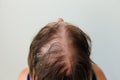 Hair loss in the form of alopecia areata. Royalty Free Stock Photo