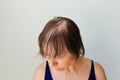 Hair loss in the form of alopecia areata. Royalty Free Stock Photo
