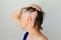 Hair loss in the form of alopecia areata. Royalty Free Stock Photo