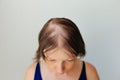 Hair loss in the form of alopecia areata.