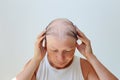 Hair loss in the form of alopecia areata. Royalty Free Stock Photo