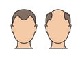 Hair loss man icon cartoon vector logo. Hair loss male scalp bald illustration