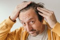 Hair loss, man looking at the mirror concerned about losing his hair at forehead Royalty Free Stock Photo