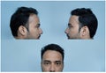 Hair loss or  Receding hairline in man Royalty Free Stock Photo