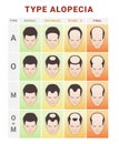 Hair loss stages infographic medical education scheme vector flat baldness types info chart