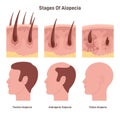 Hair loss stages. Male alopecia or balding process. Man head side view Royalty Free Stock Photo