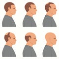 Hair loss stages vector isolated. Male alopecia. Set of balding process. Hairless man heads side view.